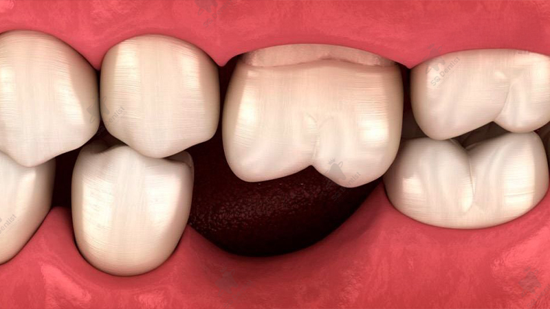 Mất răng số 6 có ảnh hưởng gì không?