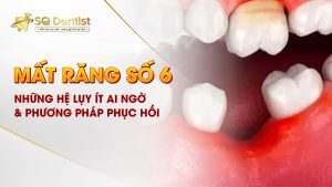 Mất răng số 6