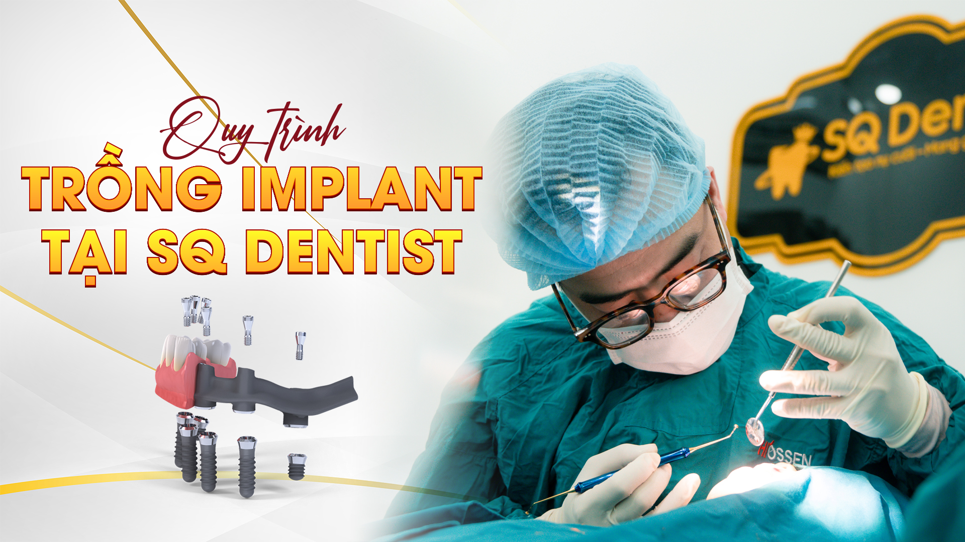 Quy trình trồng răng Implant tại SQ Dentist