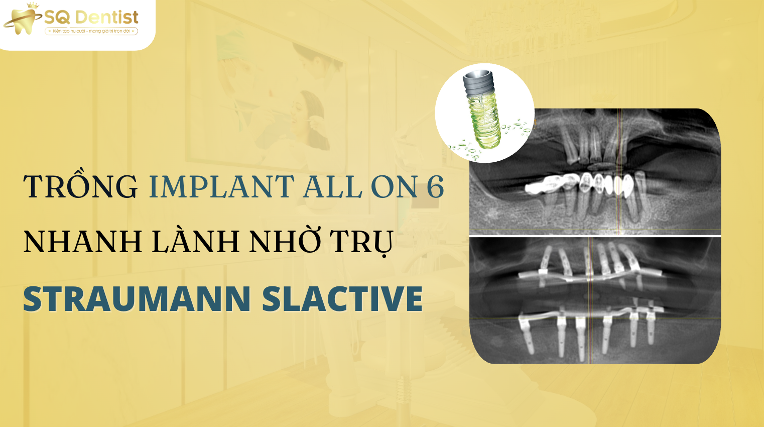 Trồng Implant All On 6 Nhanh Lành Nhờ Trụ SLActive?