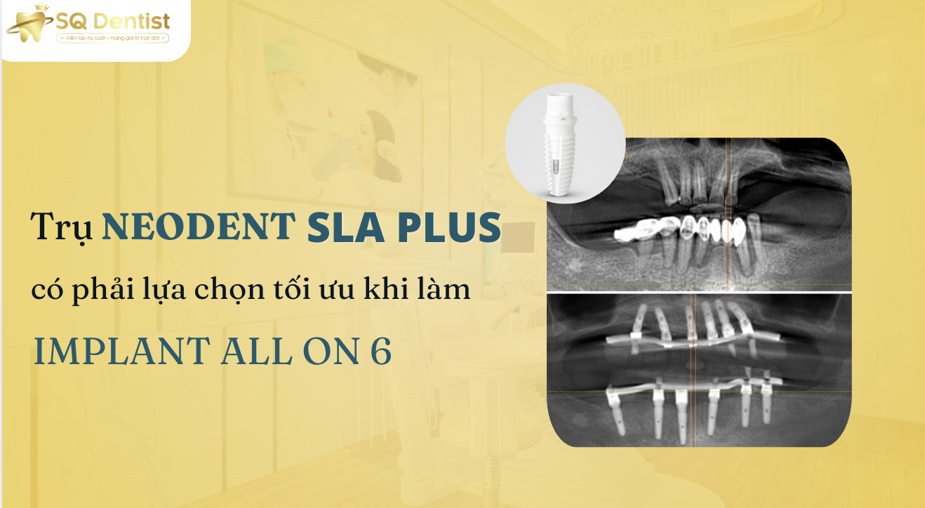 Trụ SLA Plus có phải lựa chọn tối ưu khi làm All On 6?