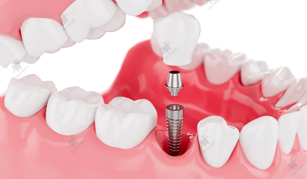 Trồng răng implant 1 răng