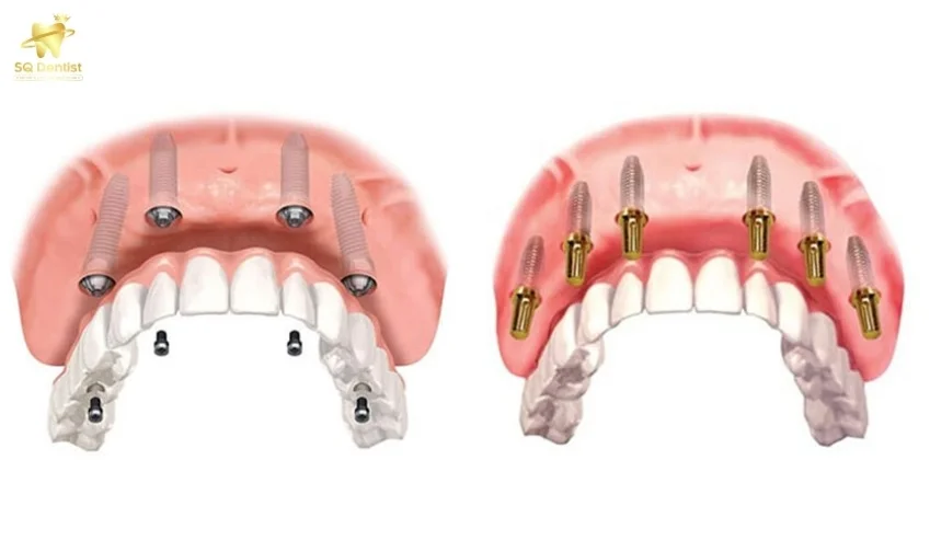 Implant toàn hàm All on 4 All on 6
