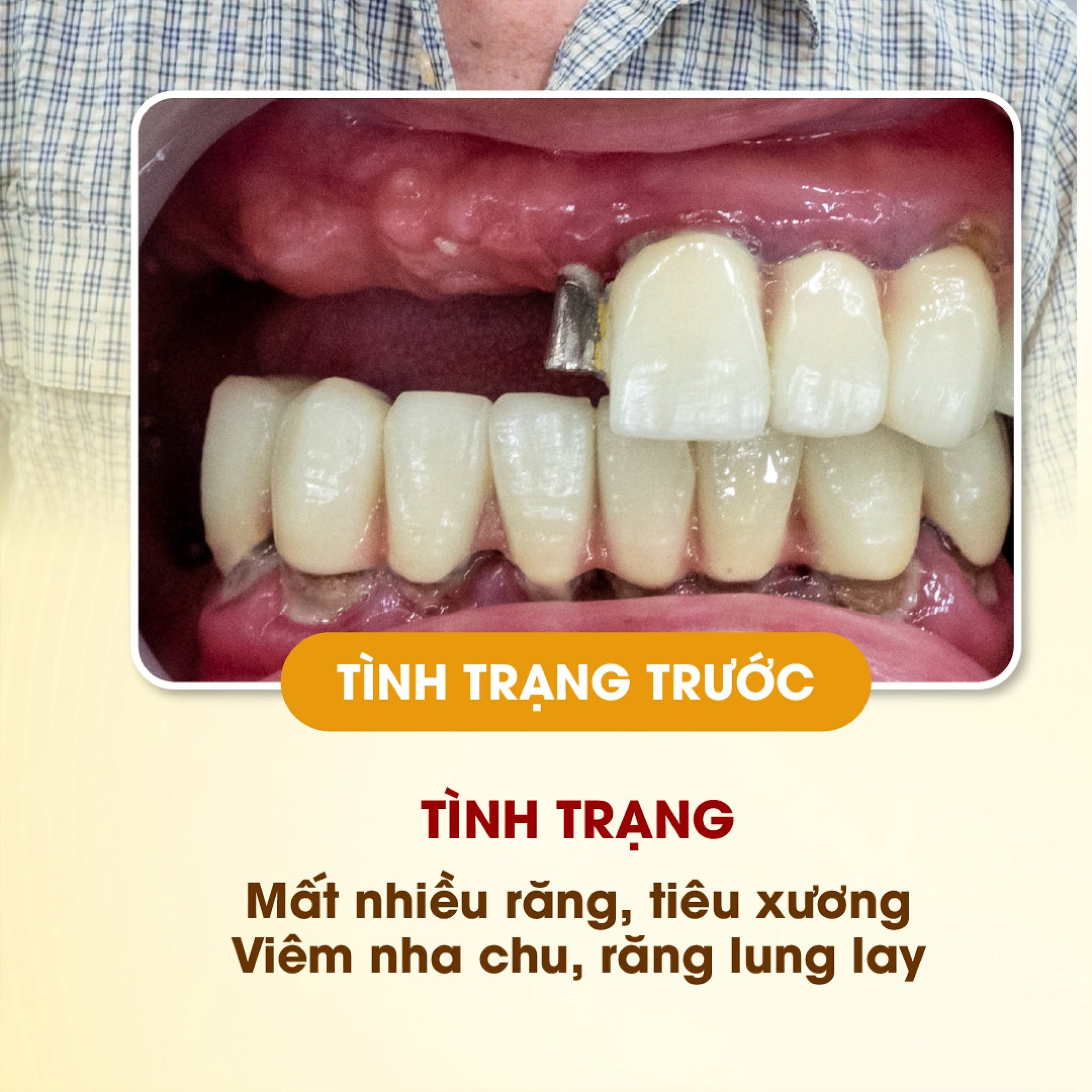 Tình trạng mất nhiều răng khiến ăn nhai khó