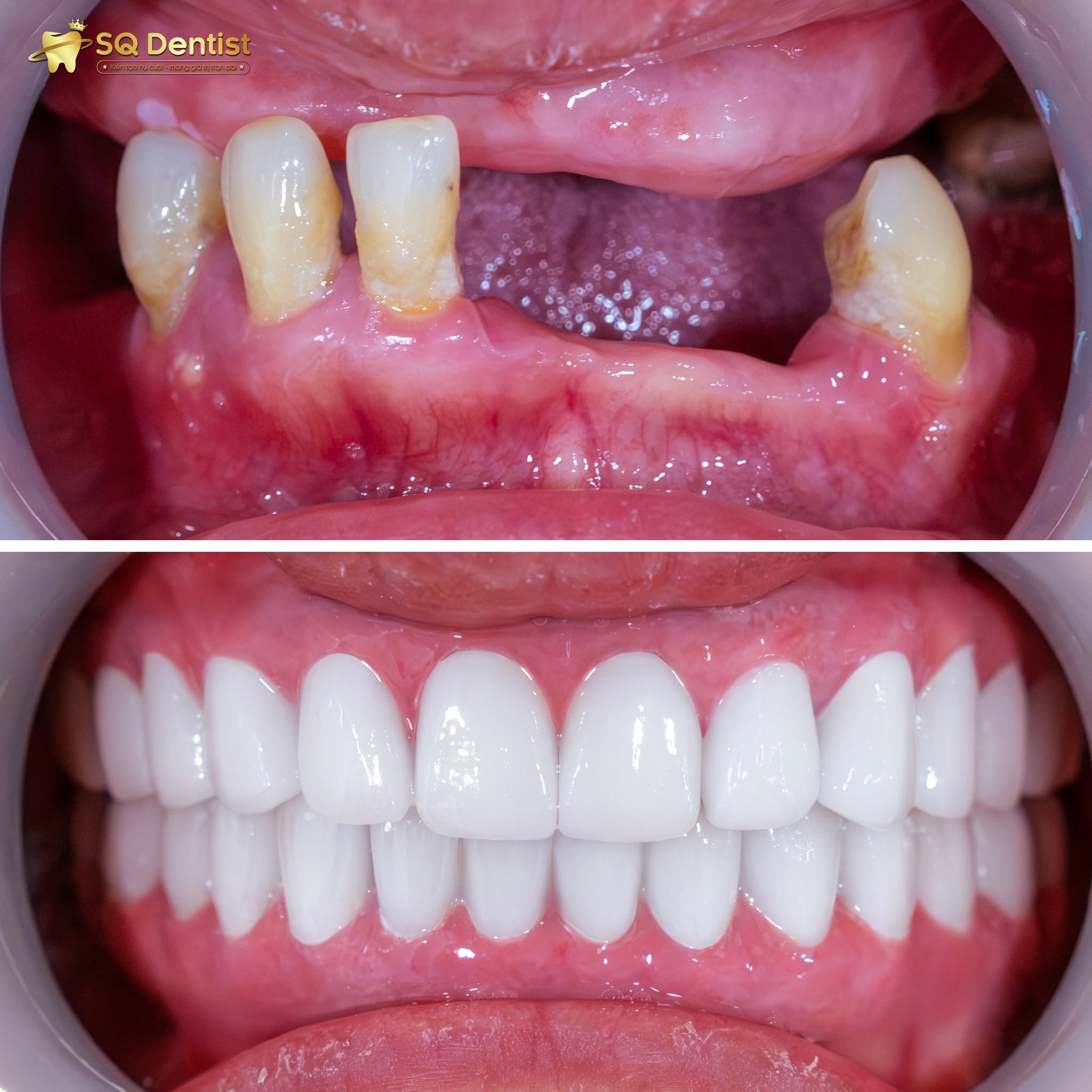 Người lớn tuổi mất răng lâu năm