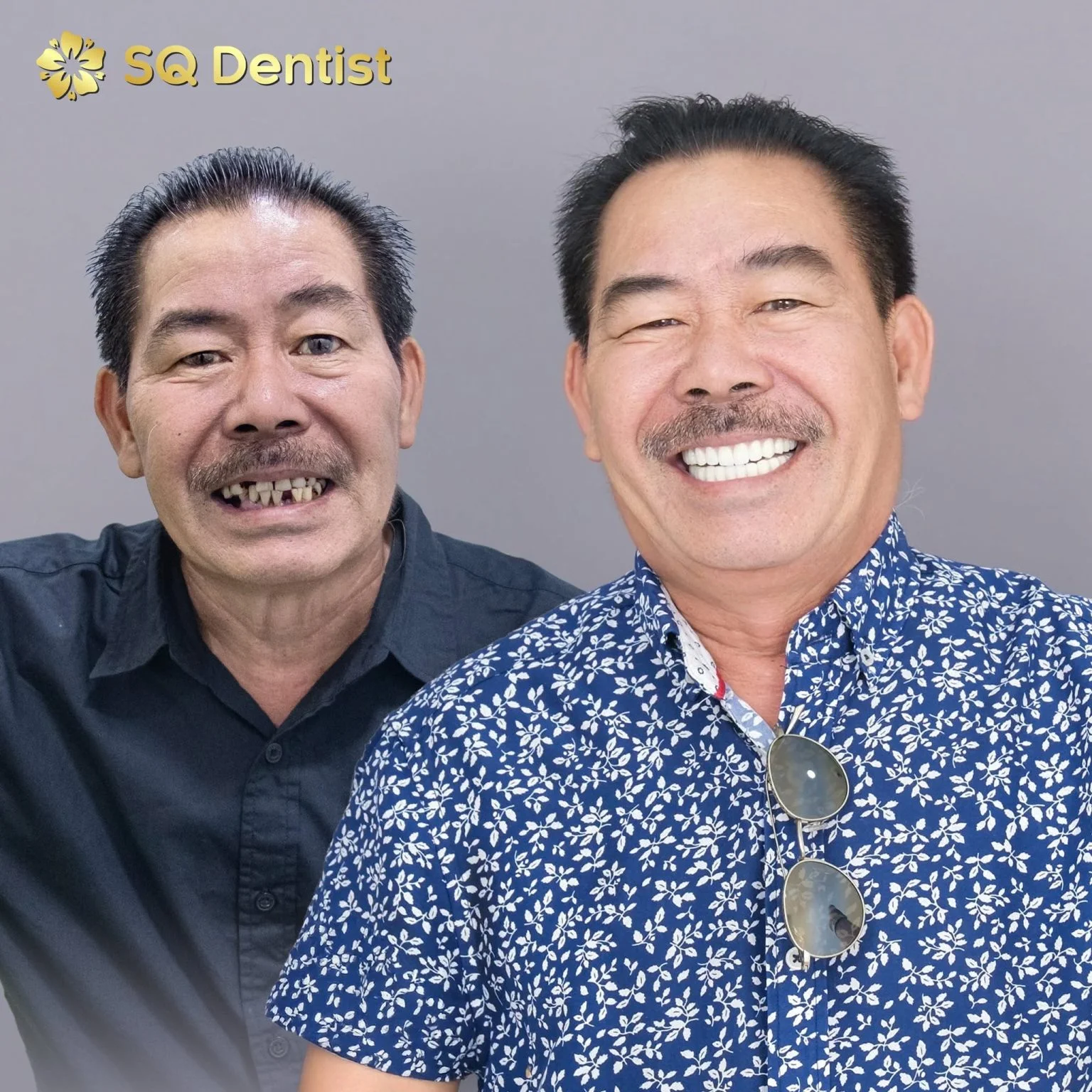 Khách hàng Chú Thế Đào - Cấy Zygoma
