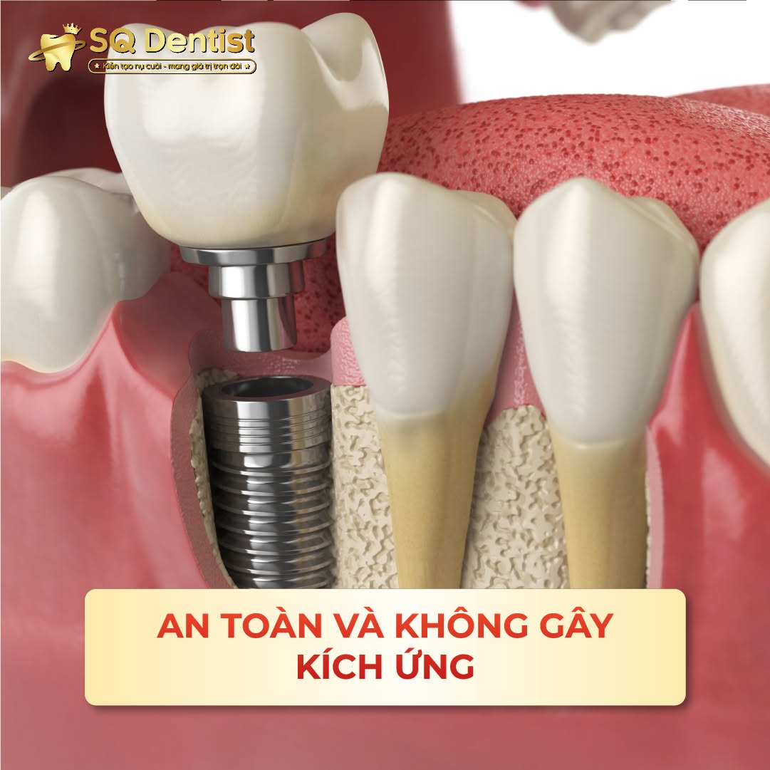 Implant đơn lẻ SQ Dentist