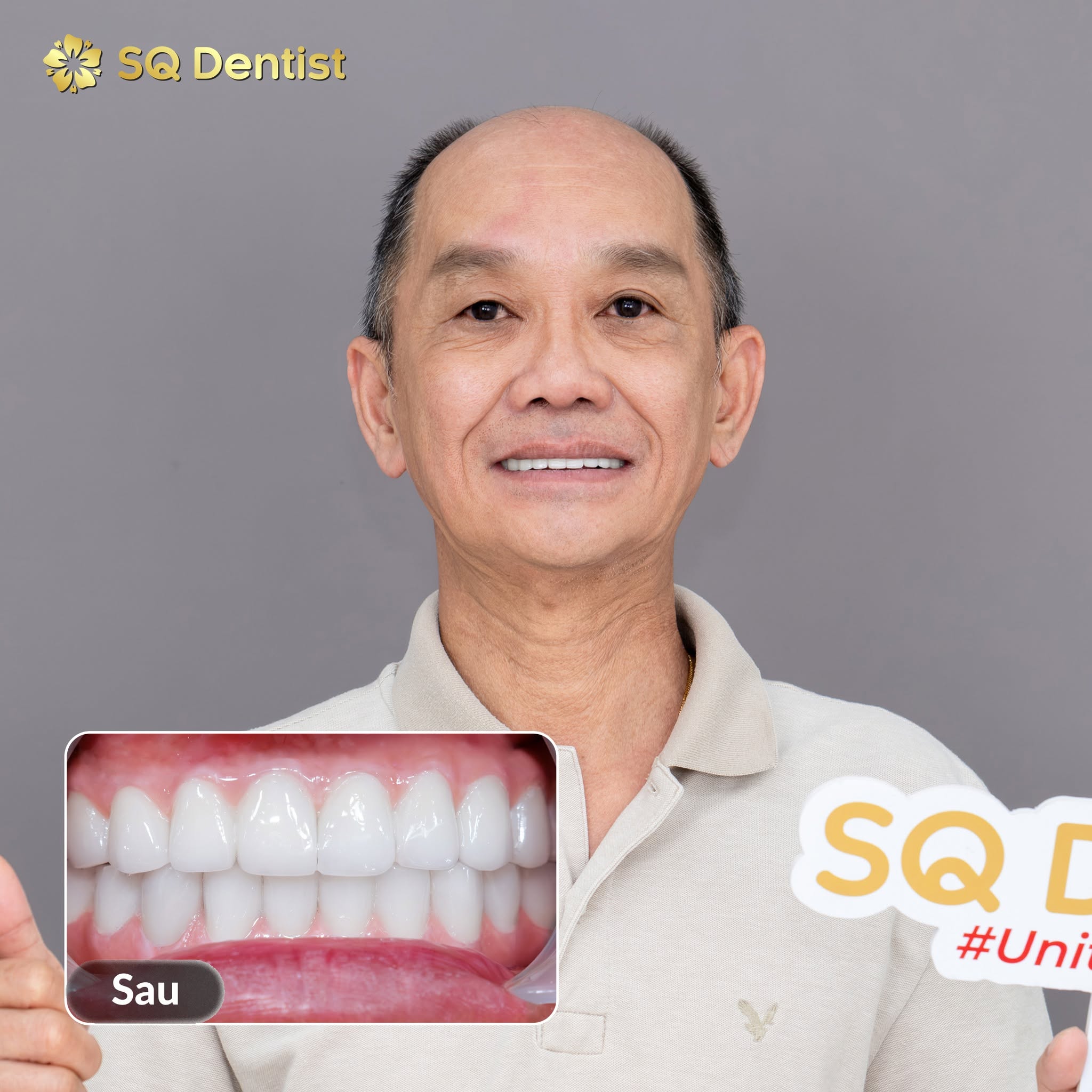 Nụ cười hoàn thiện sau cấy ghép Implant