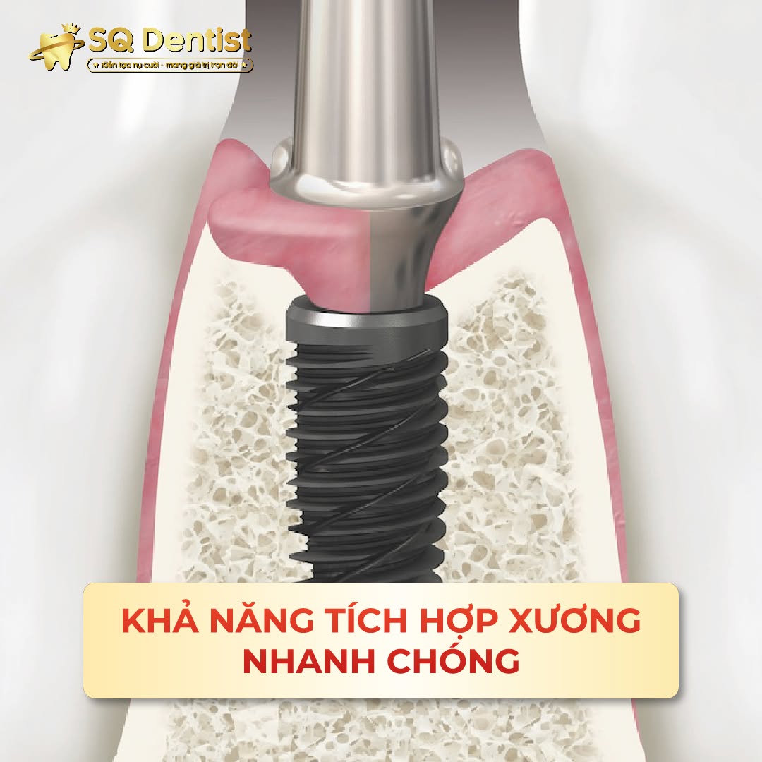 Cấu tạo răng implant