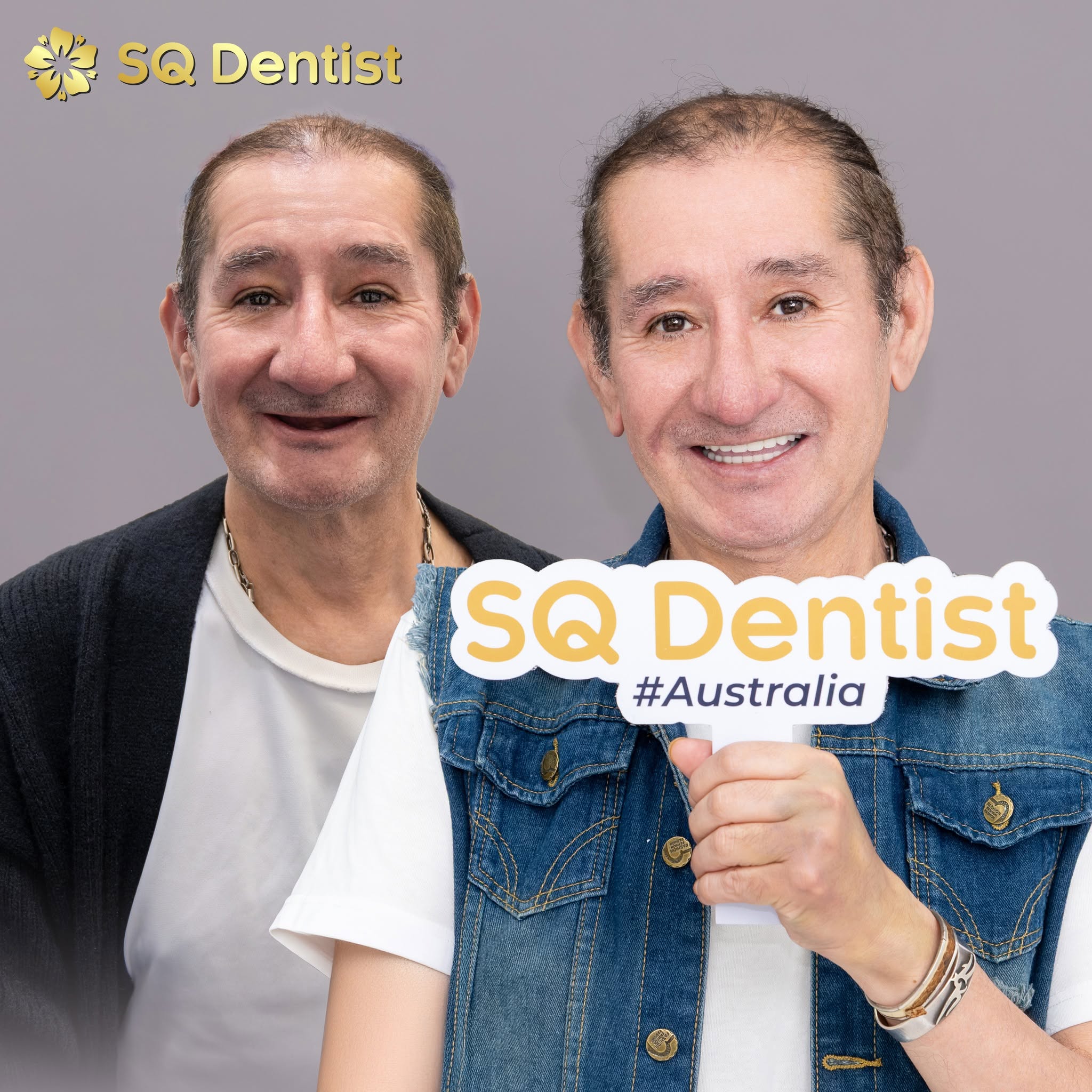 Implant xương gò má Zygoma SQ Dentist